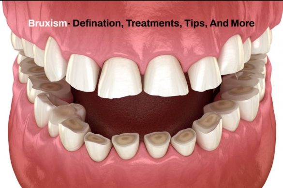 Bruxism- Defination, Treatments, Tips, And More