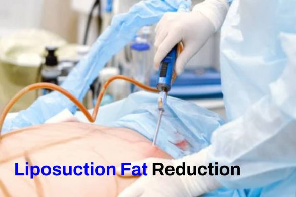 Liposuction Fat Reduction- Definition, Precations, Causes, And More