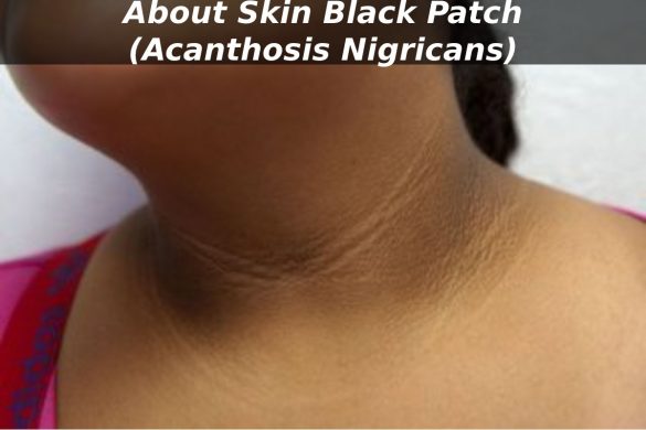 About Skin Black Patch (Acanthosis Nigricans)