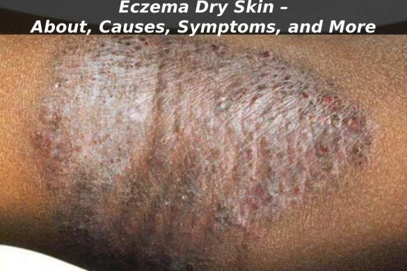 Eczema Dry Skin – About, Causes, Symptoms, and More