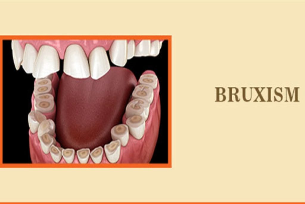 Bruxism- Defination, Treatments, Tips, And More