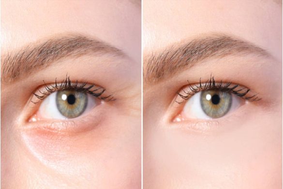 remove wrinkles under eyes